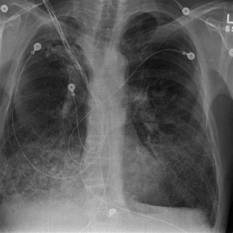Admission Chest X Ray Shows Bilateral Infiltrates And Chronic