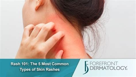 Rash 101 The 5 Most Common Types Of Skin Rashes