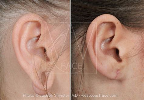 Earlobe Repair Lobuloplasty West Coast Face