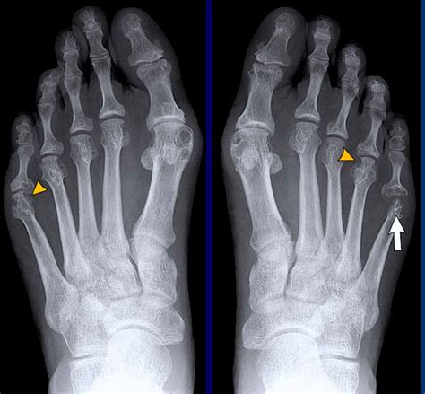 Rheumatoid Arthritis X Ray Foot
