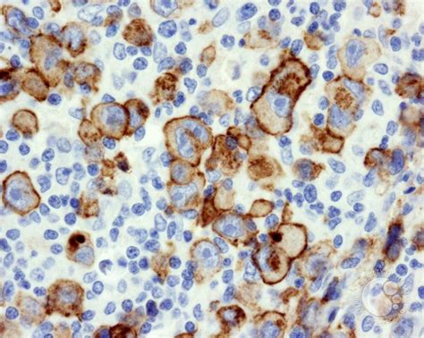 Diffuse Large B Cell Lymphoma Anaplastic Variant 6