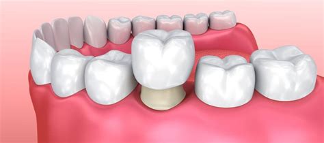 Dental Crowns Vs Implants All The Major Differences Health Blogster