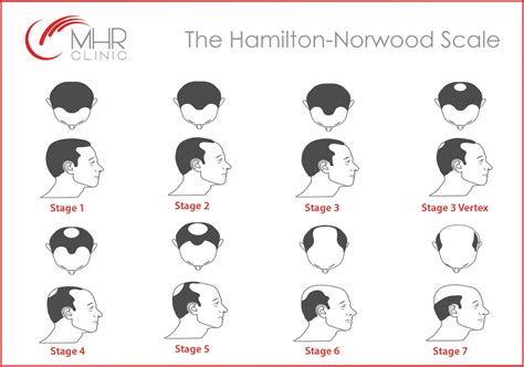 The Hamilton Norwood Scale Of Baldness Your Hair Treatment