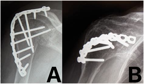 Shoulder Arthrodesis In The Management Of Glenohumeral Pathologies