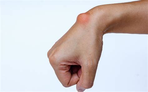 Ganglion Cysts Melbourne Hand Therapy