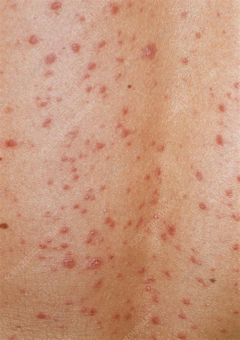 Guttate Psoriasis Skin Rash Stock Image M240 0356 Science Photo C2b