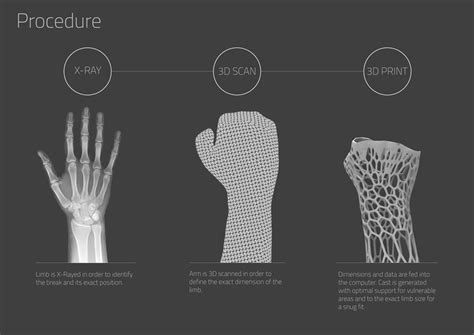 Cortex 3d Printed Cast For Fractures Nicola Ginzler