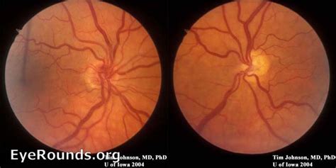 Optic Nerve Hypoplasia Bilateral Hereditary Ocular Diseases