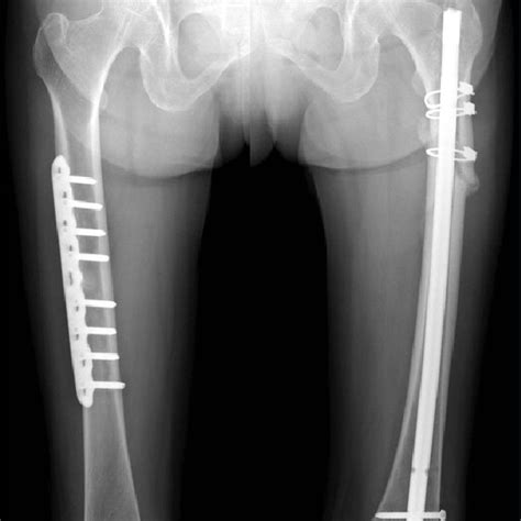 Plain Radiograph Of Both Femurs Linear Fracture Line With Lateral