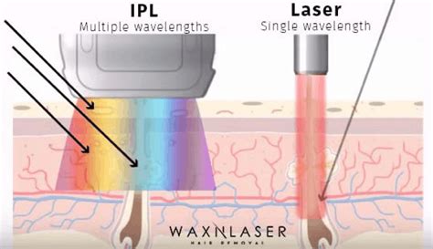 Laser Hair Removal Elos Wellington Laser Clinic