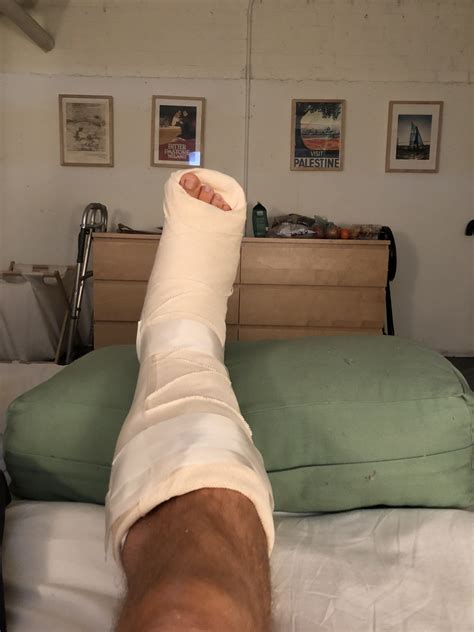 My Experience With Brostrom Surgery Ankle Ligament Repair James Dilworth