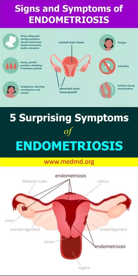 5 Surprising Symptoms Of Endometriosis Endometriosis Symptoms Endometriosis Health Facts