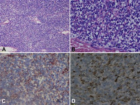 A Rare Case Of Primary Pulmonary Artery Myofibroblastic Sarcoma—imaging And Pathologic Features