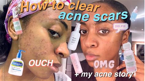 How To Clear Acne Scars Epiduo Review Tips Youtube