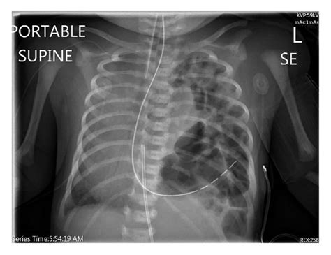 Chest Radiograph Showing Left Diaphragmatic Hernia And Contralateral