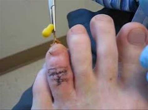 In this article i am providing some of the proven watch the following video to learn how to use these types of toe separators and toe spreaders to provide comfort and prevent blisters on your toes. Hammer Toe Surgery - YouTube