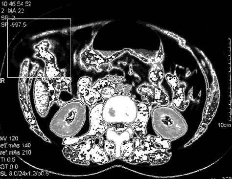 Ct Scan Showing The Disruption In The Abdominal Wall Muscles And Fascia