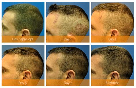 Hair Restoration With Neograft What To Expect Nashville Hair Doctor