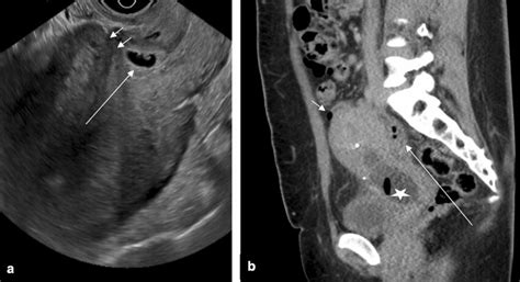Partial Uterine Perforation In A 26 Year Old Woman Following
