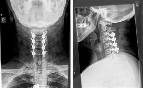 Anteroposterior Ap And Lateral Postoperative Cervical X Rays Ap And
