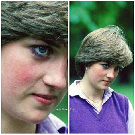 Princess Diana Had A Rosacea In The Early 80s