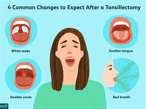 How To Get Rid Of Swollen Hard Tonsil