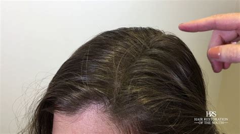 Scalp Camouflage For Hair Loss Keratin Fiber Youtube