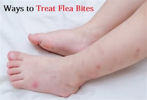 How To Treat Flea Bites