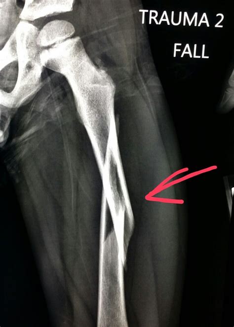 Leg Fracture X Ray