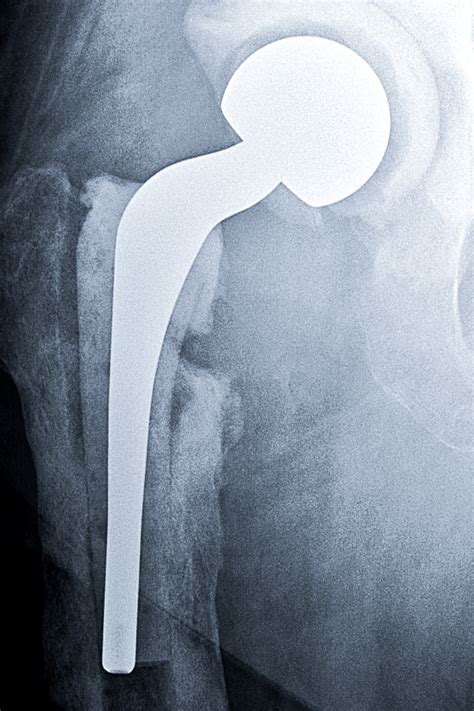 Infected Hip Replacement Adam Sassoon M D M S