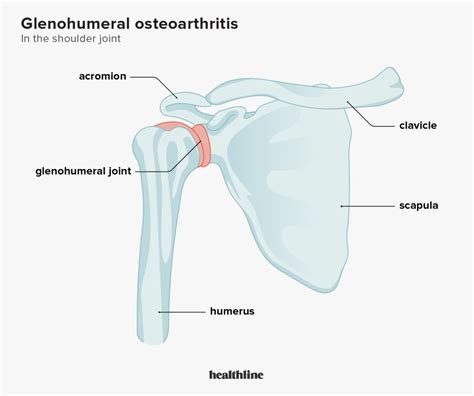 Glenohumeral Osteoarthritis Causes Symptoms And Treatment