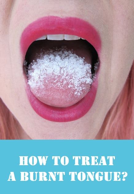 7 Best Home Remedies For Burnt Tongue With Your Kitchen Ingredients
