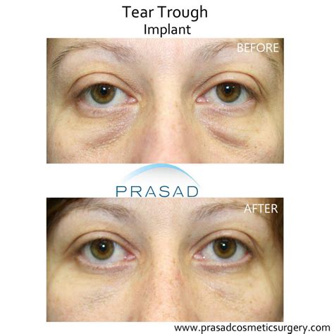 What Is The Best Treatment For Under Eye Hollows Dr Prasad Blog