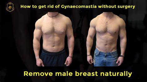 How To Get Rid Of Gynaecomastia Without Surgery Remove Male Breast Naturally Youtube