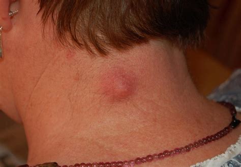 What Type Of Cancer Causes Lump In Neck Cancerwalls