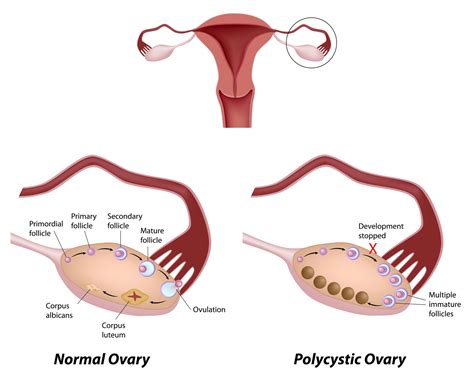 Polycystic ovary syndrome (pcos) is one of the most common endocrine and me...