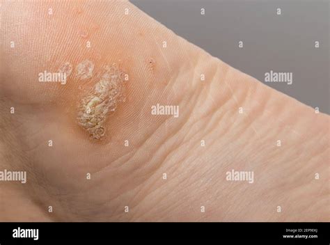 Viral Warts On Sole Foot Hi Res Stock Photography And Images Alamy