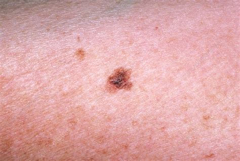 Malignant Melanoma Blemish On The Skin Stock Image M1310176