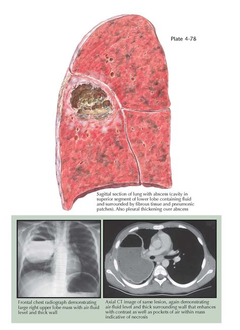 Lung Abscess Pediagenosis