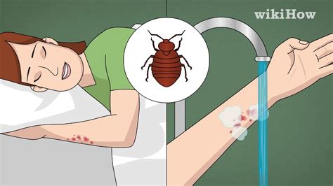 How To Treat Bed Bug Bites Youtube