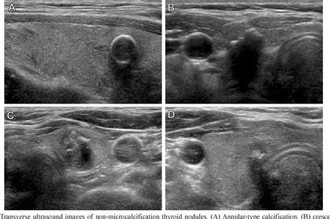 Relationship Between Patterns Of Calcification In Thyroid Nodules And
