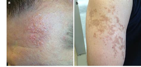 37 Year Old Male Patient With A Yellowish Dermal Plaque On The Left