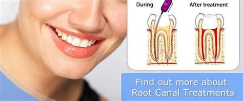 This is a dentist who specialises in root canal treatment. How Root Canal Treatment can Help for Your Dental Issues?