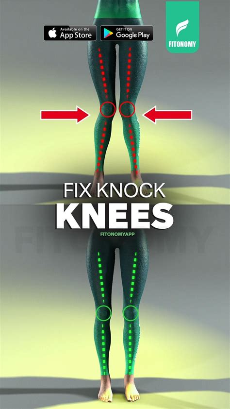 How To Fix Knock Knees Yogalove Fyp Home Artofit