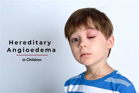 Hereditary Angioedema In Children Types Causes And Symptoms