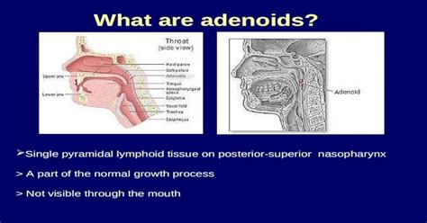 Adenoids Hypertrophy Ppt Powerpoint