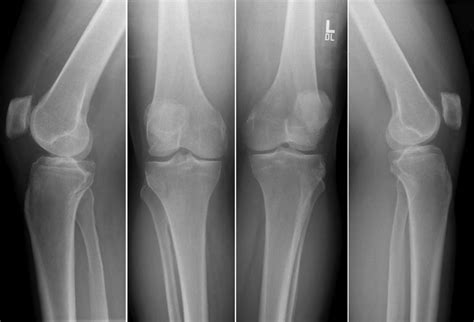 Sixty Six Year Old Male With Several Years Of Bilateral Knee Pain Knee