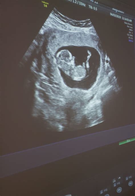 Pregnancy Ultrasound When Is The Best Time To See My Baby