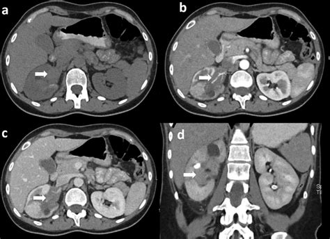 Plain And Postcontrast Ct Abdomen Axial Plain Ct Abdomen Shows A Mild