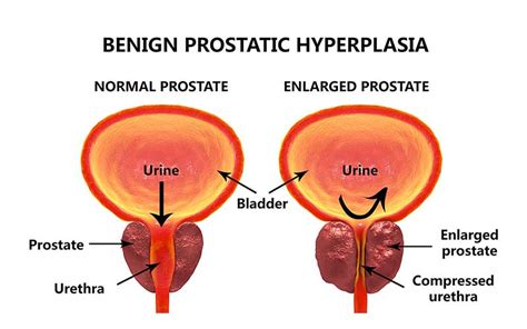 What Does Prostate Cancer Do Bobby Vincent S Blog